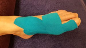 Hallux valgus